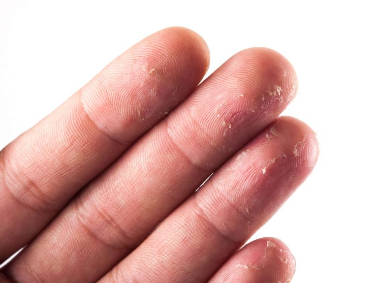 Mẹo hay trị da tay khô nứt nẻ hiệu quả vào mùa đông